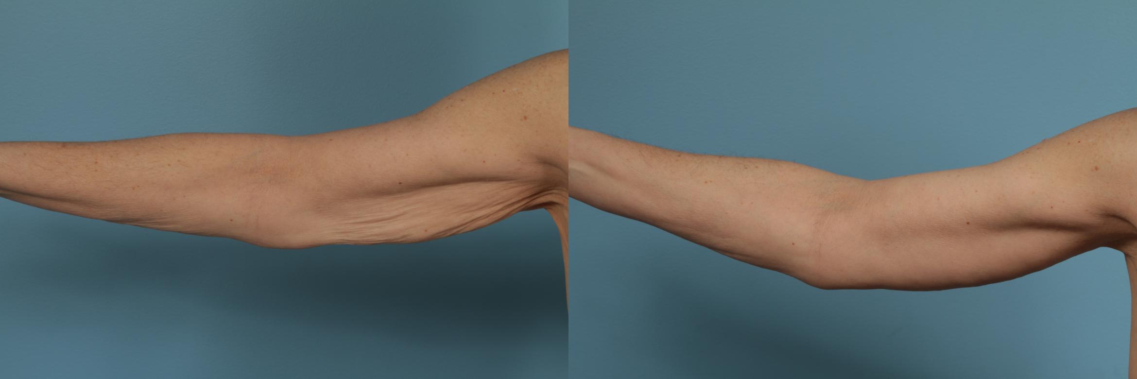 Before & After Arm Lift (Brachioplasty) Case 282 View #3 View in Chicago, IL