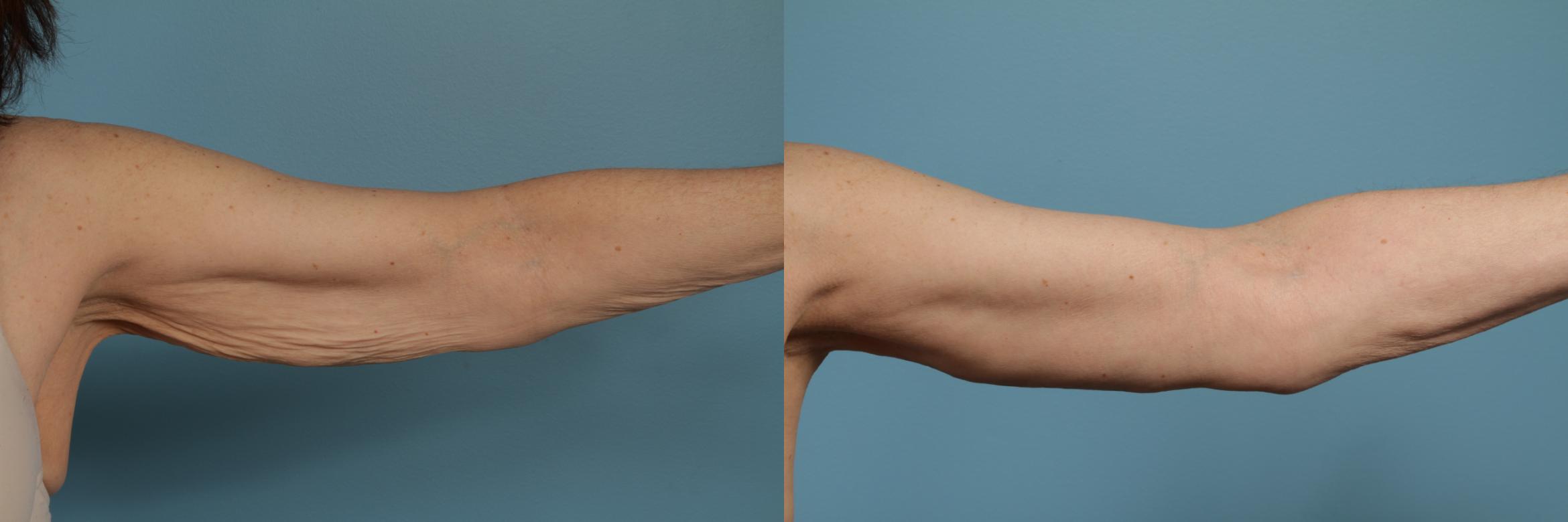 Before & After Arm Lift (Brachioplasty) Case 282 View #4 View in Chicago, IL