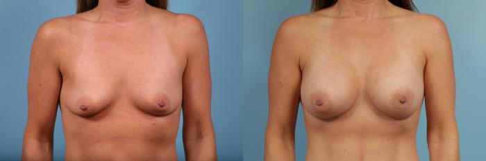 Before & After Breast Augmentation Case 102 View #1 View in Chicago, IL