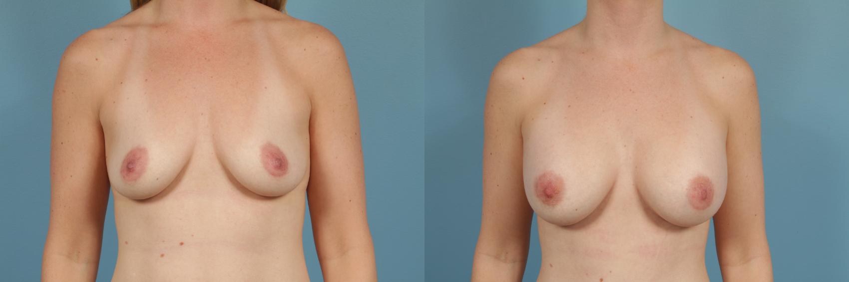Before & After Breast Augmentation Case 204 View #1 View in Chicago, IL