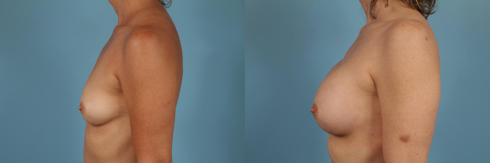 Before & After Breast Augmentation Case 207 View #2 View in Chicago, IL