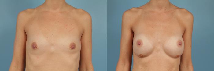 Before & After Breast Augmentation Case 223 View #1 View in Chicago, IL