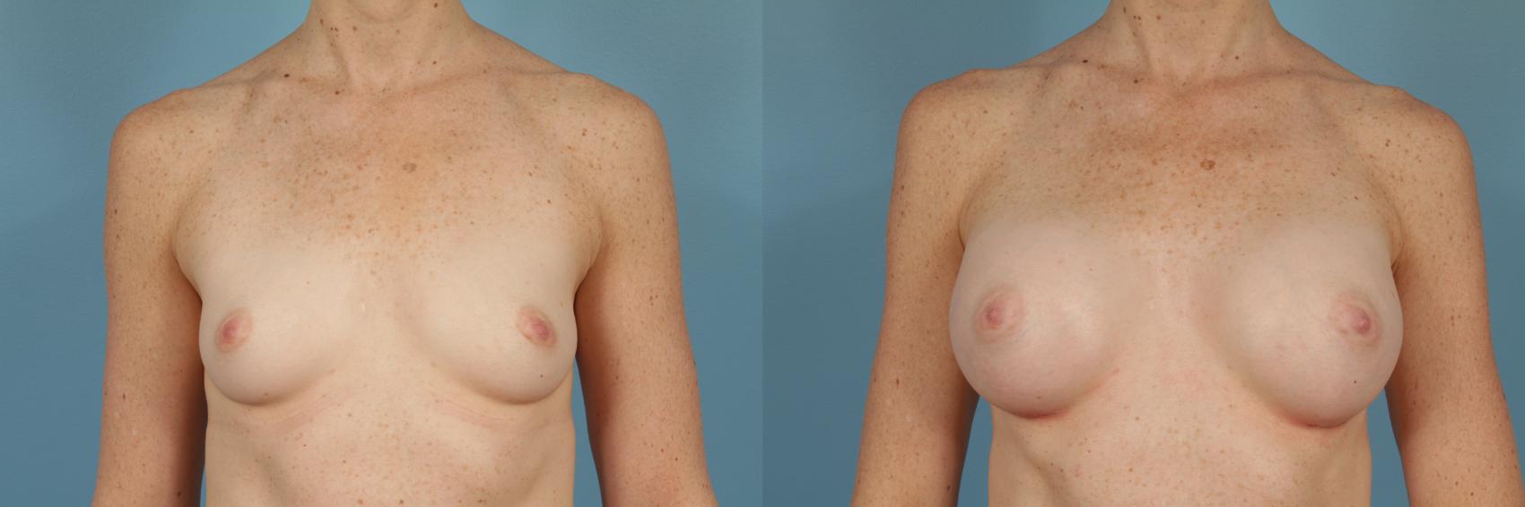 Before & After Breast Augmentation Case 240 View #1 View in Chicago, IL
