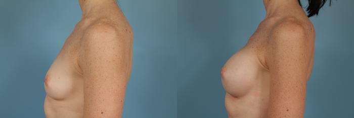 Before & After Breast Augmentation Case 240 View #2 View in Chicago, IL