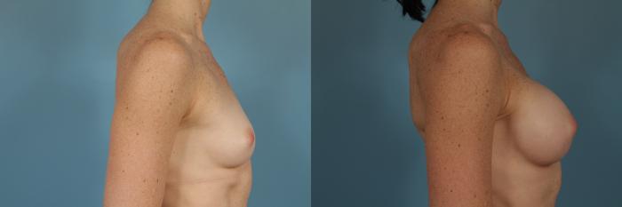 Before & After Breast Augmentation Case 240 View #3 View in Chicago, IL