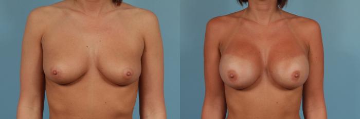 Before & After Breast Augmentation Case 247 View #1 View in Chicago, IL