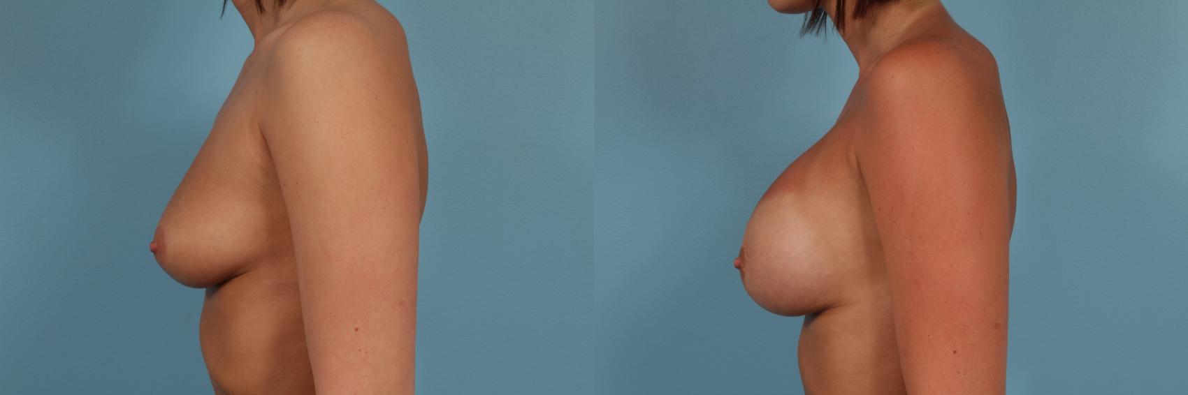 Before & After Breast Augmentation Case 247 View #2 View in Chicago, IL