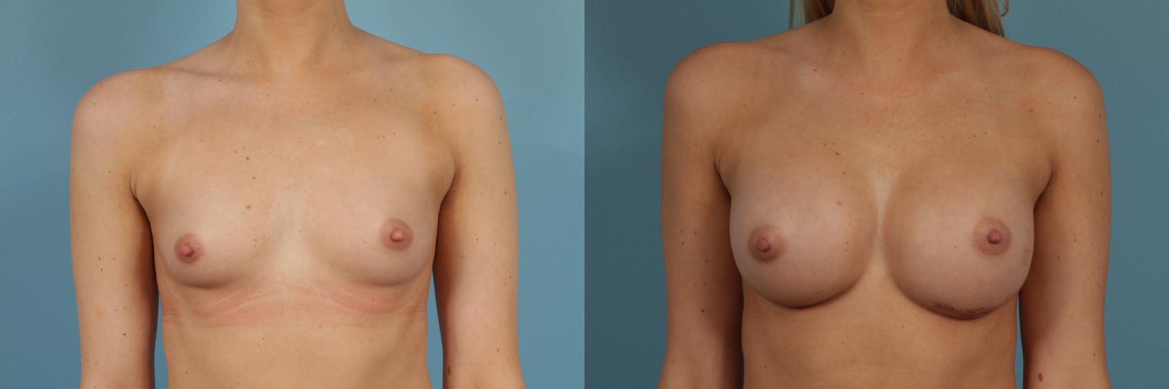 Before & After Breast Augmentation Case 259 View #1 View in Chicago, IL