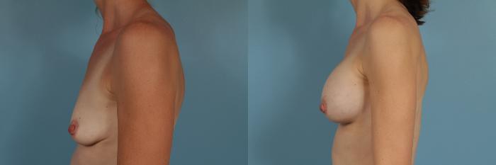 Before & After Breast Augmentation Case 262 View #2 View in Chicago, IL