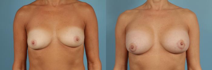 Before & After Breast Augmentation Case 263 View #1 View in Chicago, IL