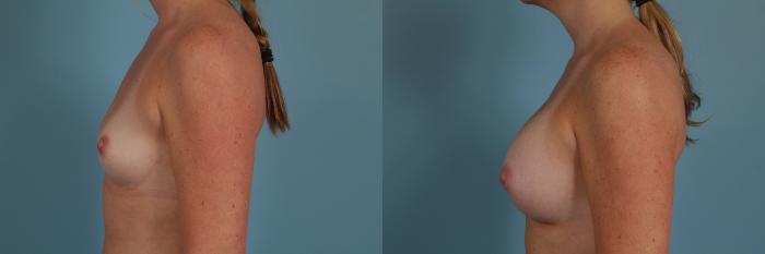 Before & After Breast Augmentation Case 277 View #2 View in Chicago, IL