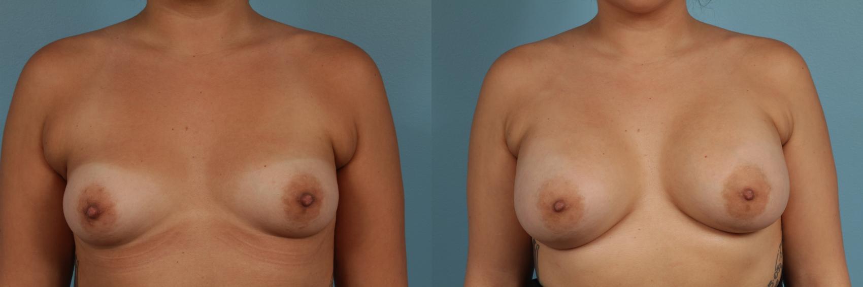 Before & After Breast Augmentation Case 291 View #1 View in Chicago, IL