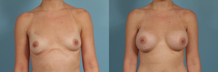 Before & After Breast Augmentation Case 300 View #1 View in Chicago, IL