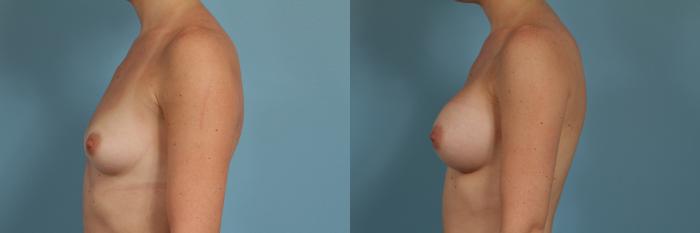 Before & After Breast Augmentation Case 300 View #2 View in Chicago, IL