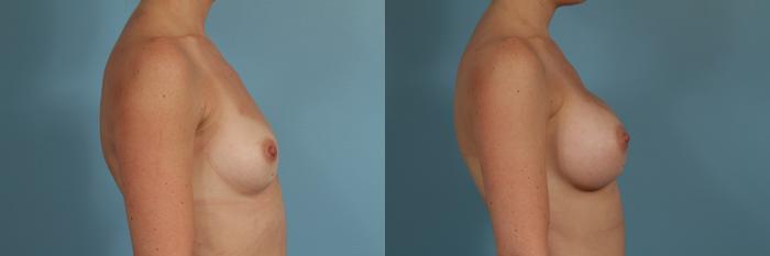 Before & After Breast Augmentation Case 300 View #3 View in Chicago, IL