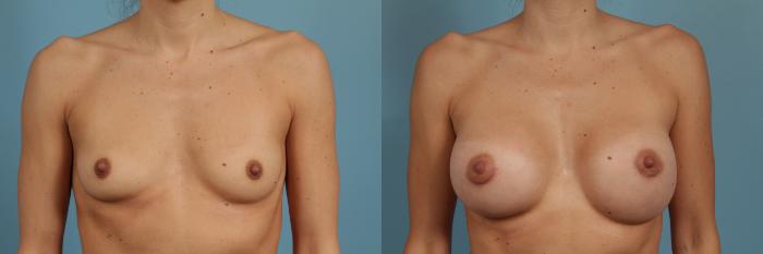 Before & After Breast Augmentation Case 301 View #1 View in Chicago, IL
