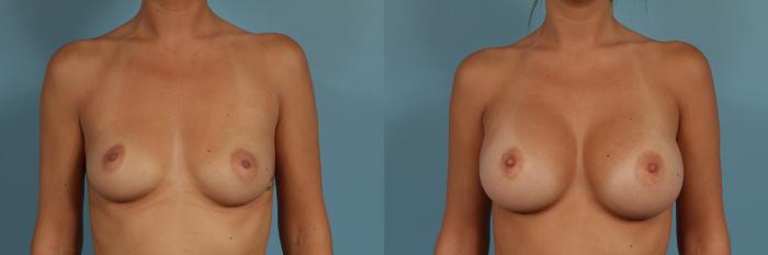 Before & After Breast Augmentation Case 314 View #1 View in Chicago, IL