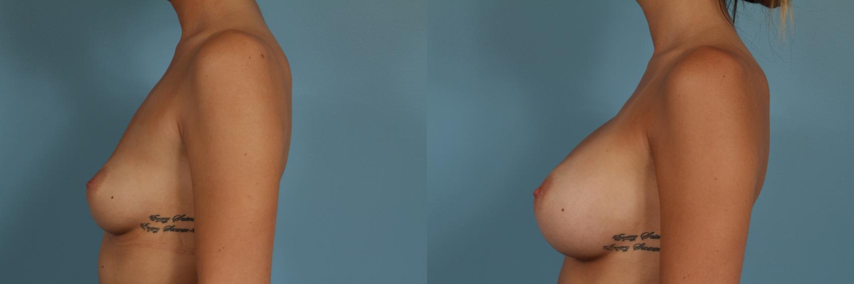 Before & After Breast Augmentation Case 314 View #2 View in Chicago, IL