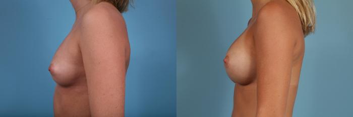 Before & After Breast Augmentation Case 322 View #2 View in Chicago, IL