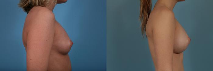 Before & After Breast Augmentation Case 322 View #3 View in Chicago, IL