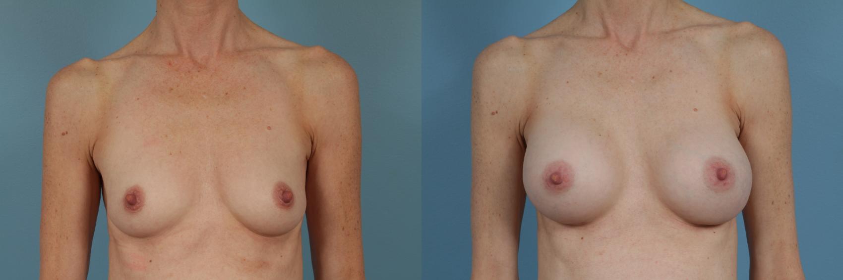 Before & After Breast Augmentation Case 339 View #1 View in Chicago, IL