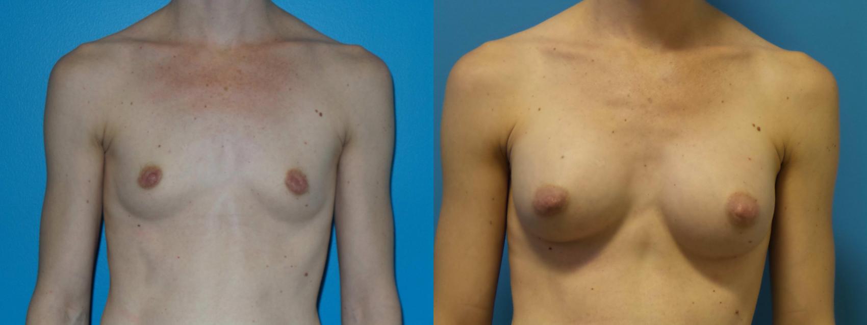 Before & After Breast Augmentation Case 420 View #1 View in Chicago, IL