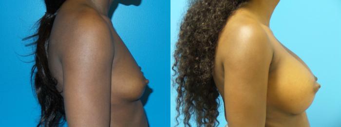 Before & After Breast Augmentation Case 429 View #2 View in Chicago, IL