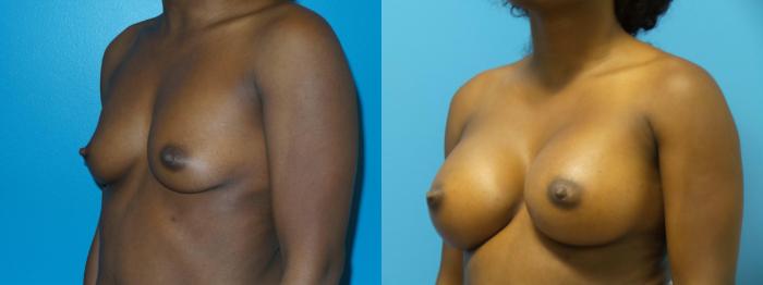 Before & After Breast Augmentation Case 429 View #3 View in Chicago, IL