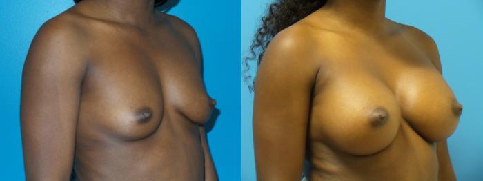 Before & After Breast Augmentation Case 429 View #4 View in Chicago, IL