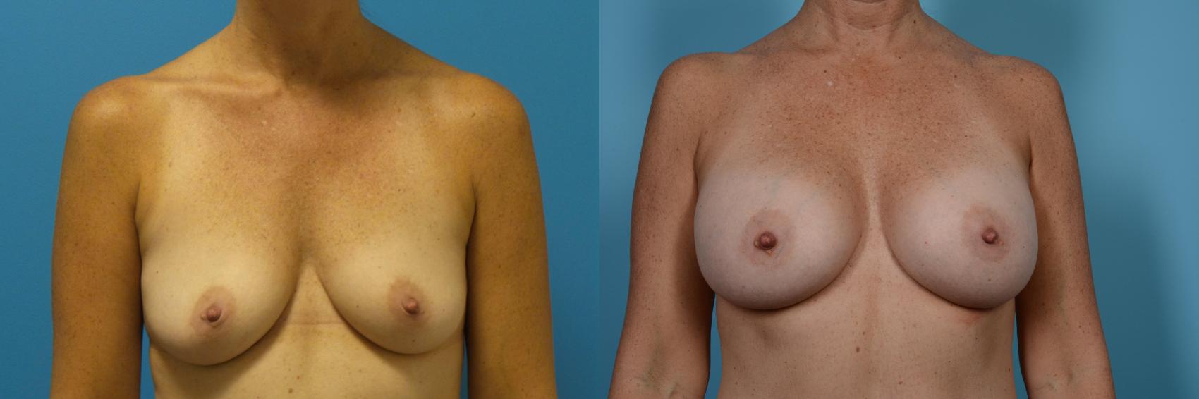 Before & After Breast Augmentation Case 457 View #1 View in Chicago, IL