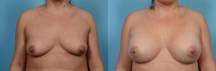 Before & After Breast Augmentation Case 474 View #1 View in Chicago, IL