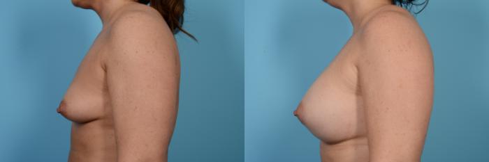 Before & After Breast Augmentation Case 474 View #2 View in Chicago, IL