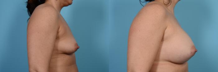 Before & After Breast Augmentation Case 474 View #3 View in Chicago, IL