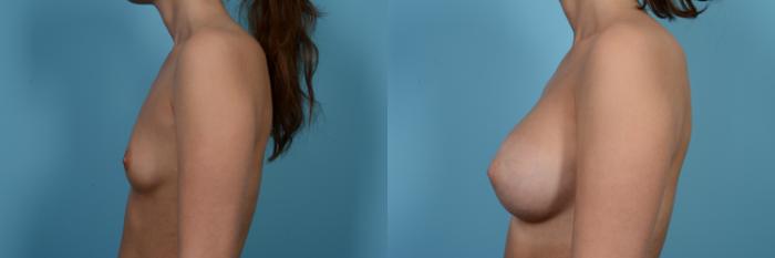 Before & After Breast Augmentation Case 477 View #2 View in Chicago, IL