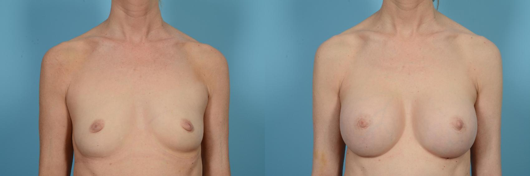 Before & After Breast Augmentation Case 497 View #1 View in Chicago, IL