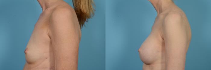 Before & After Breast Augmentation Case 497 View #3 View in Chicago, IL