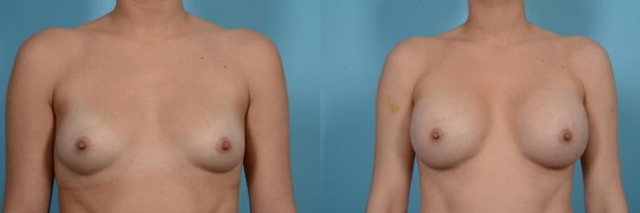 Before & After Breast Augmentation Case 512 View #1 View in Chicago, IL