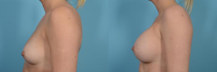 Before & After Breast Augmentation Case 512 View #2 View in Chicago, IL