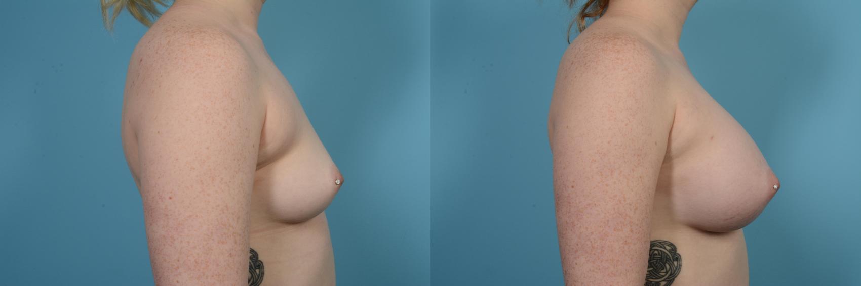 Before & After Breast Augmentation Case 516 View #3 View in Chicago, IL