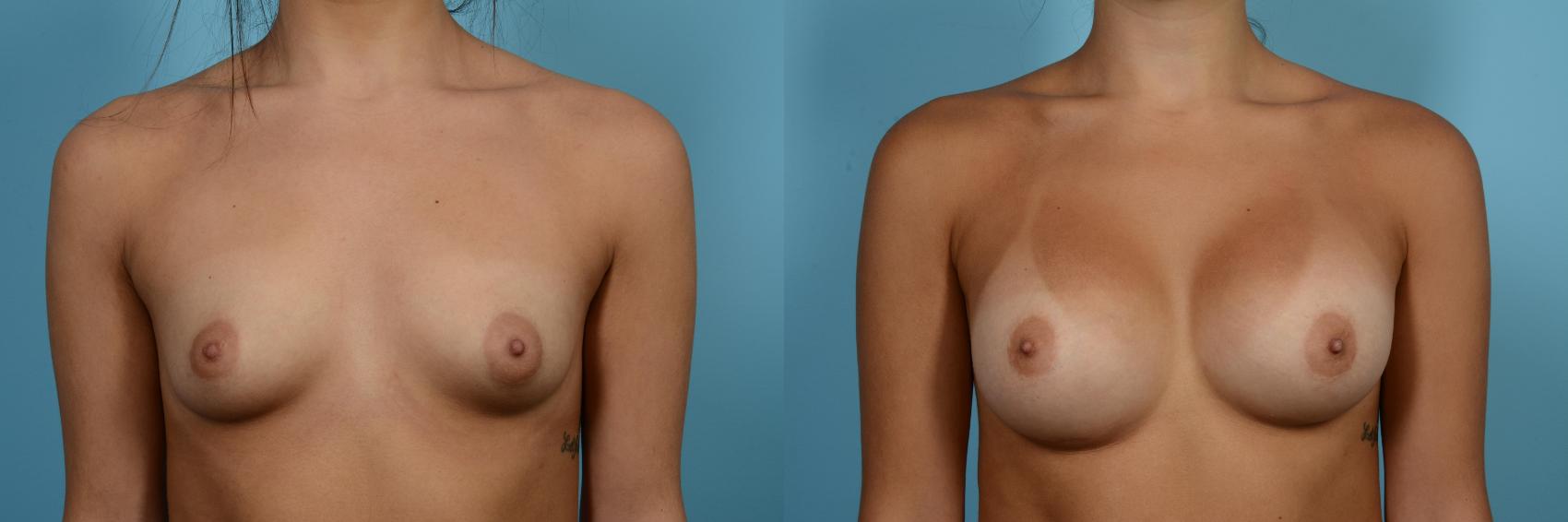 Before & After Breast Augmentation Case 541 View #1 View in Chicago, IL