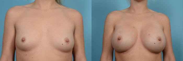 Before & After Breast Augmentation Case 557 View #1 View in Chicago, IL
