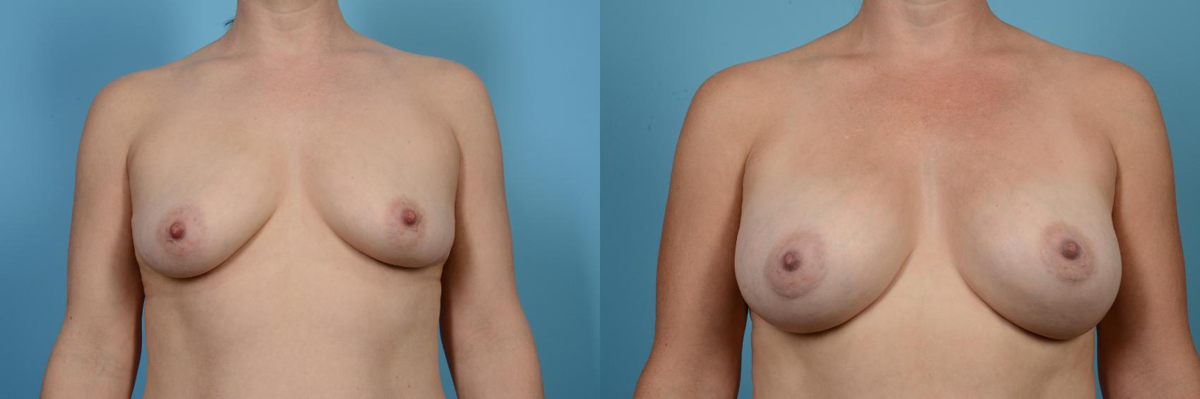 Before & After Breast Augmentation Case 567 View #1 View in Chicago, IL