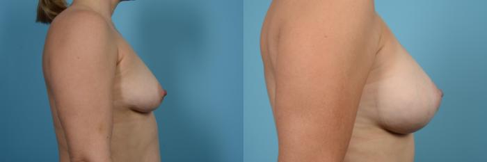 Before & After Breast Augmentation Case 567 View #3 View in Chicago, IL