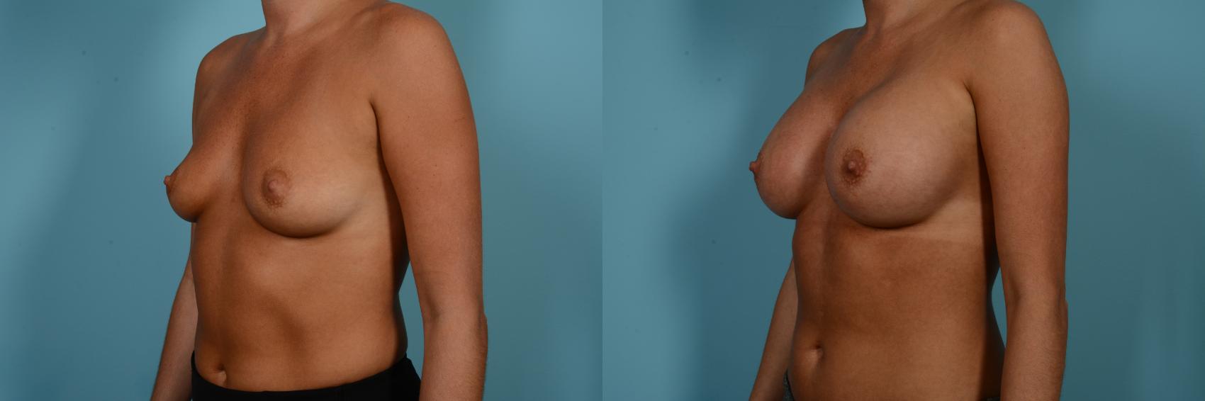 Dr. Sinno Breast Augmentation in Chicago, Illinois