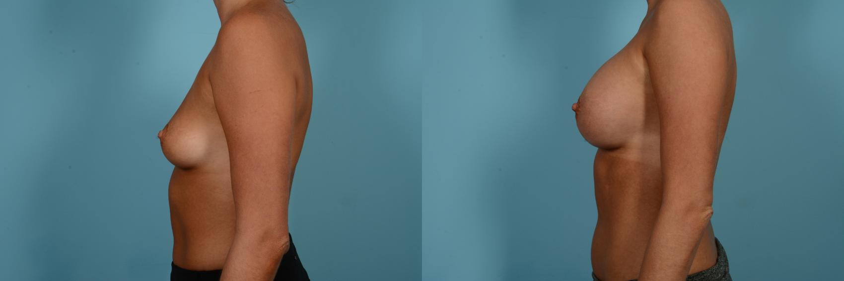Dr. Sinno Breast Augmentation in Chicago, Illinois
