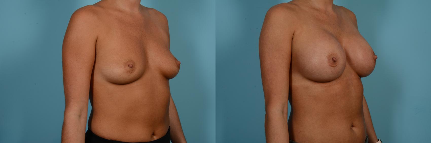 Dr. Sinno Breast Augmentation in Chicago, Illinois