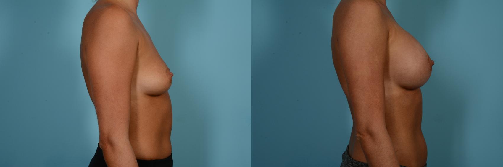 Dr. Sinno Breast Augmentation in Chicago, Illinois