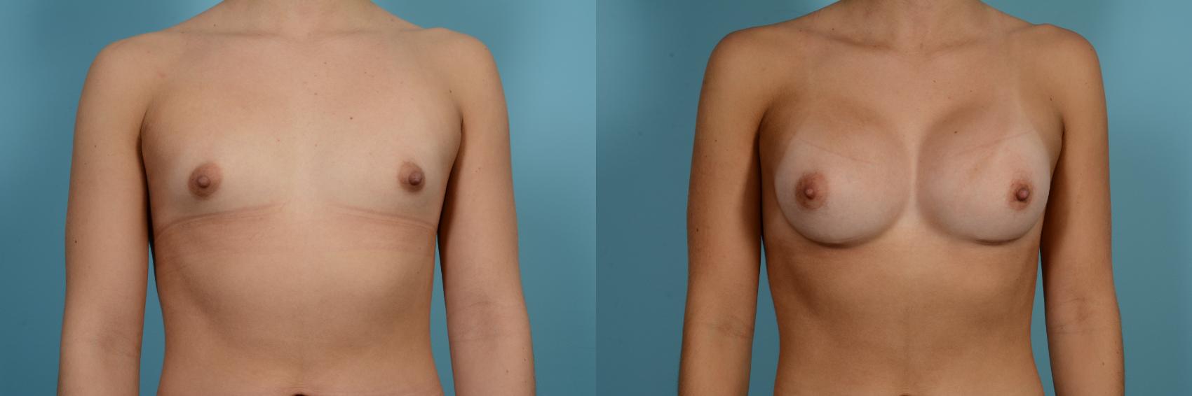 Dr. Sinno Breast Augmentation in Chicago, Illinois