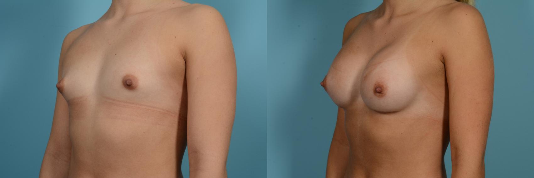 Dr. Sinno Breast Augmentation in Chicago, Illinois