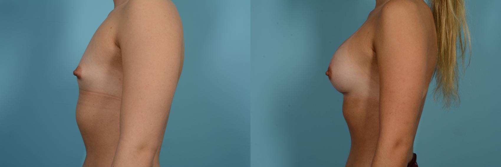 Dr. Sinno Breast Augmentation in Chicago, Illinois